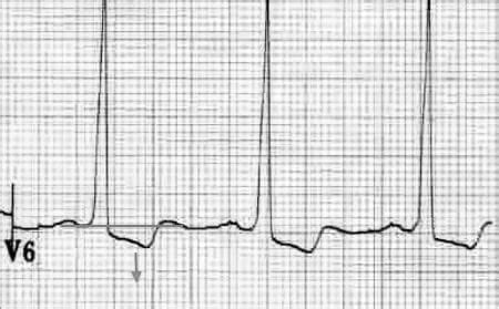 lv strain french|my lvhn sign in.